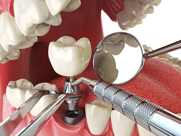 Best Broken Tooth Emergency  in Blaine, MN